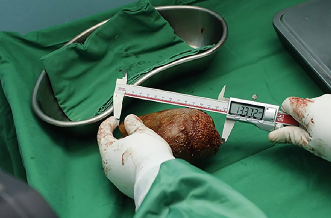 камень в почках