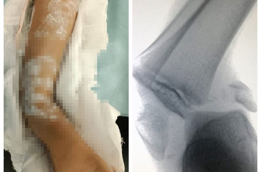  В Подмосковье ребёнок сломал лодыжки из-за прыжка на батуте