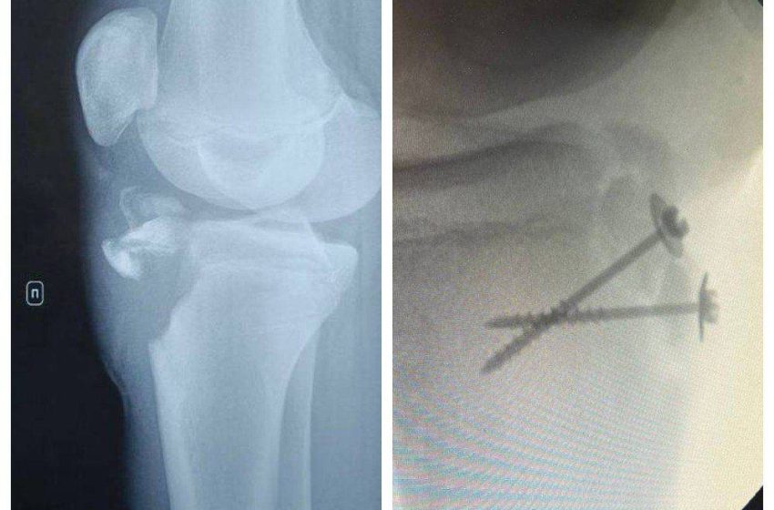  У подмосковного школьника оторвалась часть кости на ноге из-за тренировки без разминки