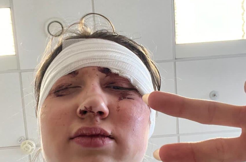 Лыжница показала травмы после завала на соревнованиях в Сочи